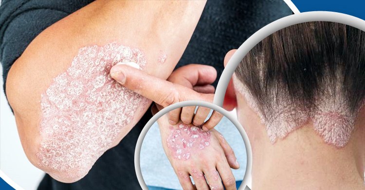  সোরিয়াসিস (Psoriasis)